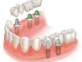 Виды стоматологического протезирования